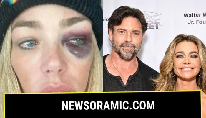 Denise Richards spotted with black eye in California