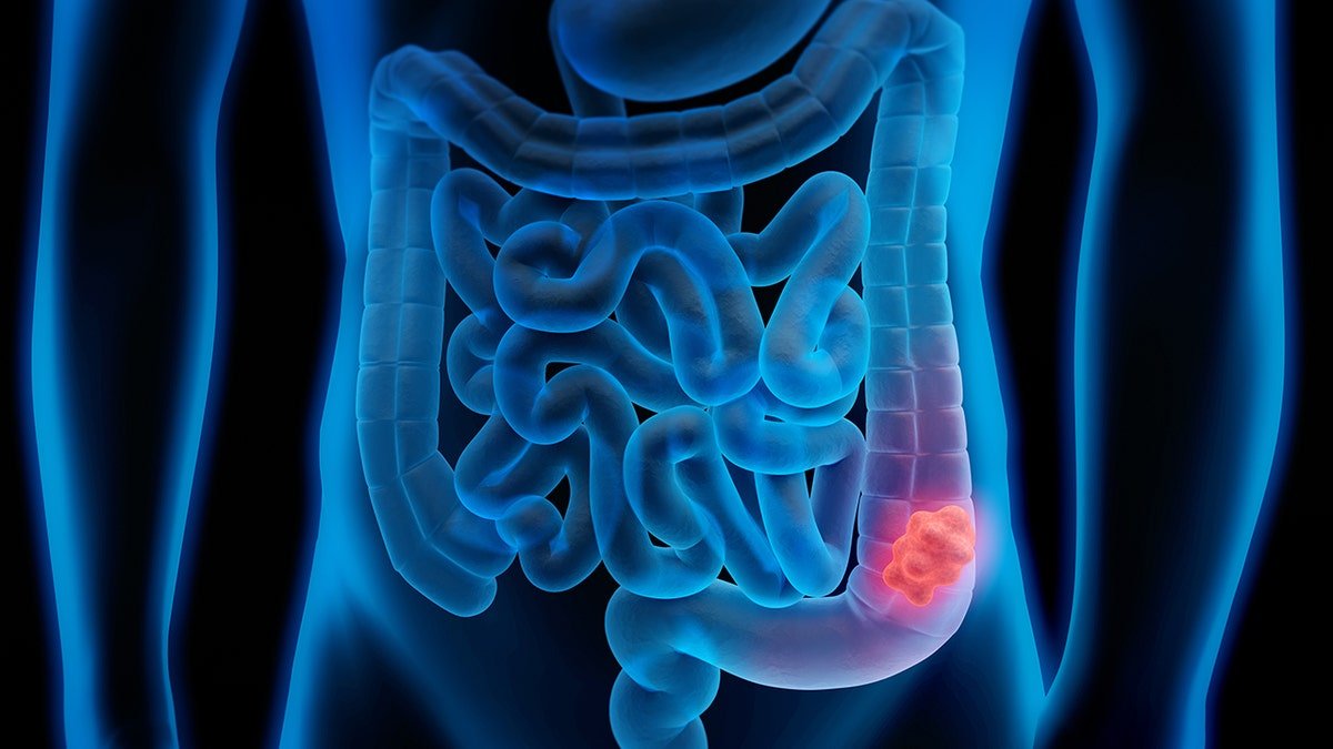 Medical illustration of Colorectal Cancer