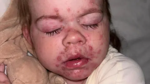 Sarah (Mia's mum) Baby Mia had a severe rash, with chickpox spots around her mouth and on her eyelids