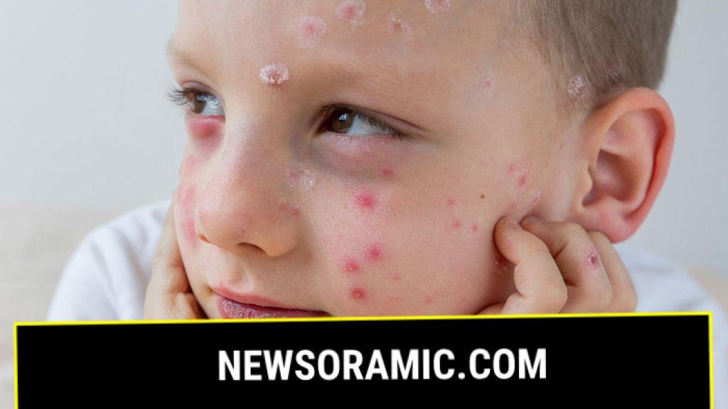 What is chickenpox and who can get the vaccine?