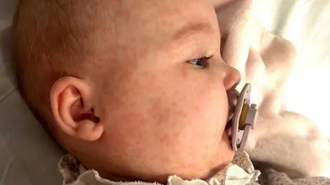 Supplied At seven months old, baby Saskia is in hospital with a distinctive red measles rash across her face. We can only see her head and she is lying on her side and has a dummy in her mouth.