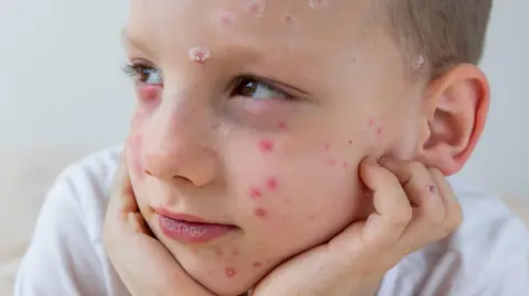 Getty Images A boy with chickenpox has used calamine lotion on his spots to reduce itching