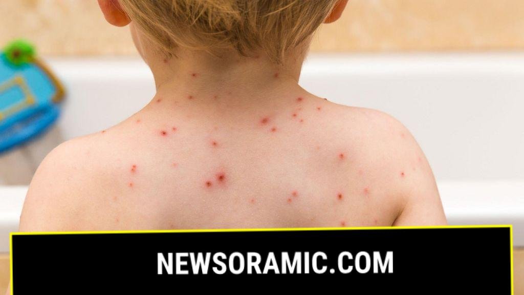 Children offered chickenpox vaccine on NHS