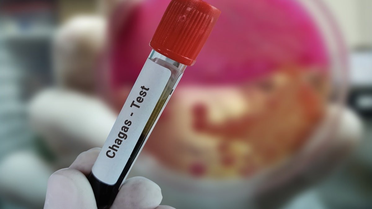 Chagas disease lab blood test