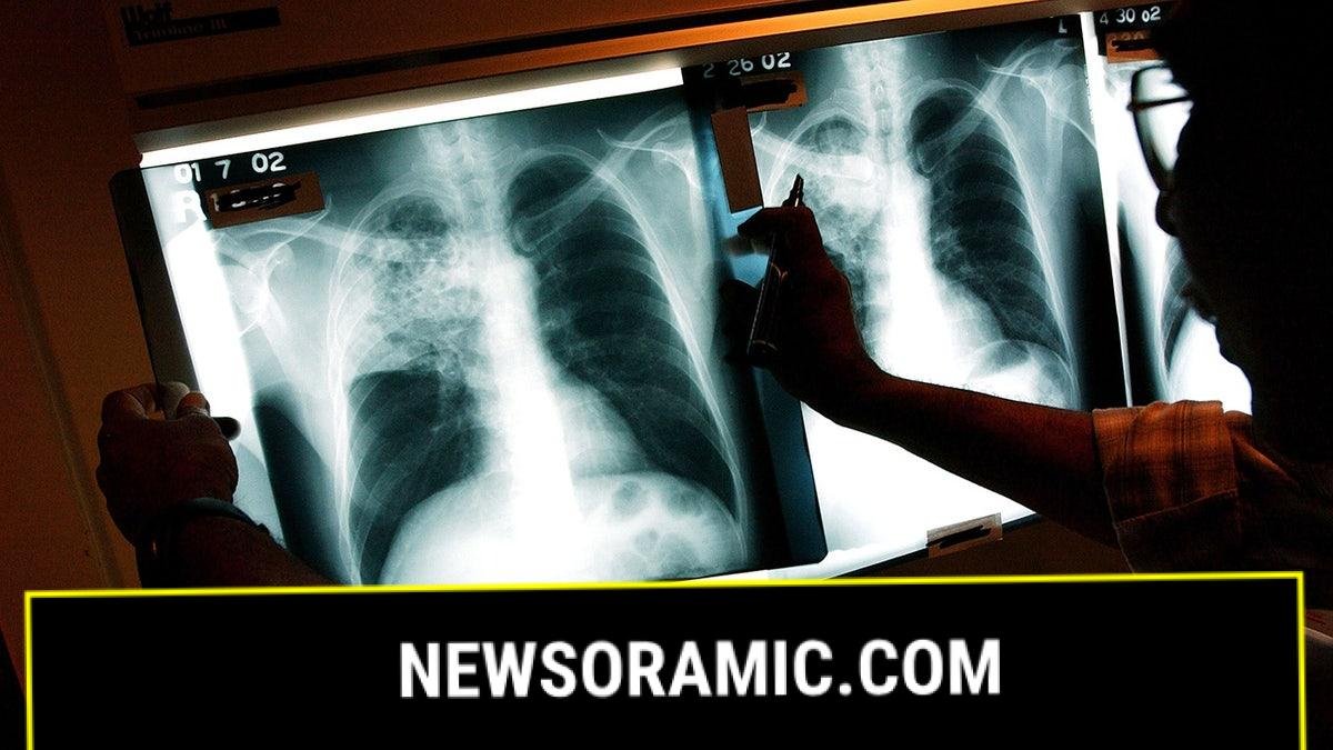 X-rays of TB patient