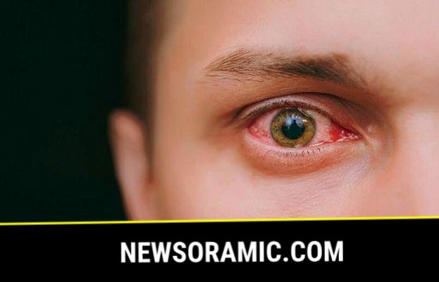 Twin cities hit by conjunctivitis surge - SUCH TV