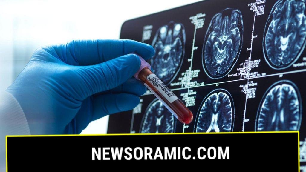 Alzheimer's blood test could 'revolutionise' diagnosis